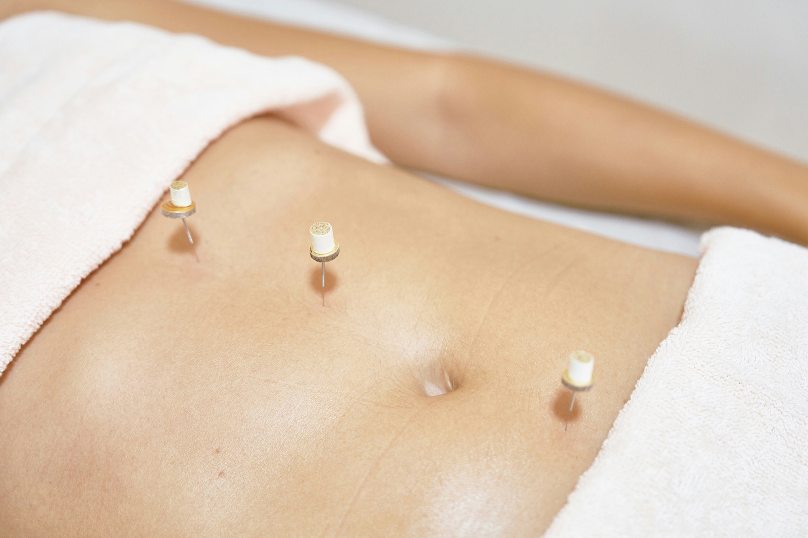 TCM acupuncture treatment